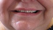 A-Smile-Transformation-with-Teeth-Whitening-Before-Image