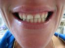 Crowns-Bridges-to-Restore-a-Smile-Before-Image