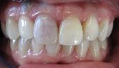 Repairing-a-Dead-Implant-with-Root-Canal-and-Internal-Bleaching-Before-Image