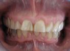 Before Teeth Whitening | Bangor ME Dentist