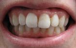 Repairing-a-Dead-Implant-with-Root-Canal-and-Internal-Bleaching-After-Image