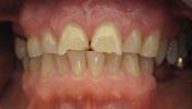 Dental-Crowns-to-Repair-Chipped-Front-Teeth-Before-Image