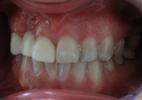 Dental-Bridge-to-Replace-Missing-Tooth-Before-Image