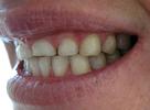 Dental Bridge Before | Maine Family Dental Practice