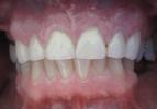 Dental-Crowns-to-Repair-Chipped-Front-Teeth-After-Image