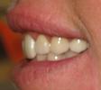 After Dental Bridge Image | Maine Family Dental Practice