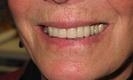 woman smiling after dental crowns | bangor me dentist