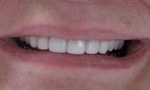 A-Smile-Transformation-with-Teeth-Whitening-After-Image