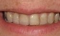 Dental-Bridge-to-Replace-Missing-Tooth-After-Image
