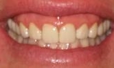 Crowns-Bridges-to-Restore-a-Smile-After-Image