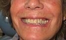 woman smiling before dental crowns | bangor me dentist